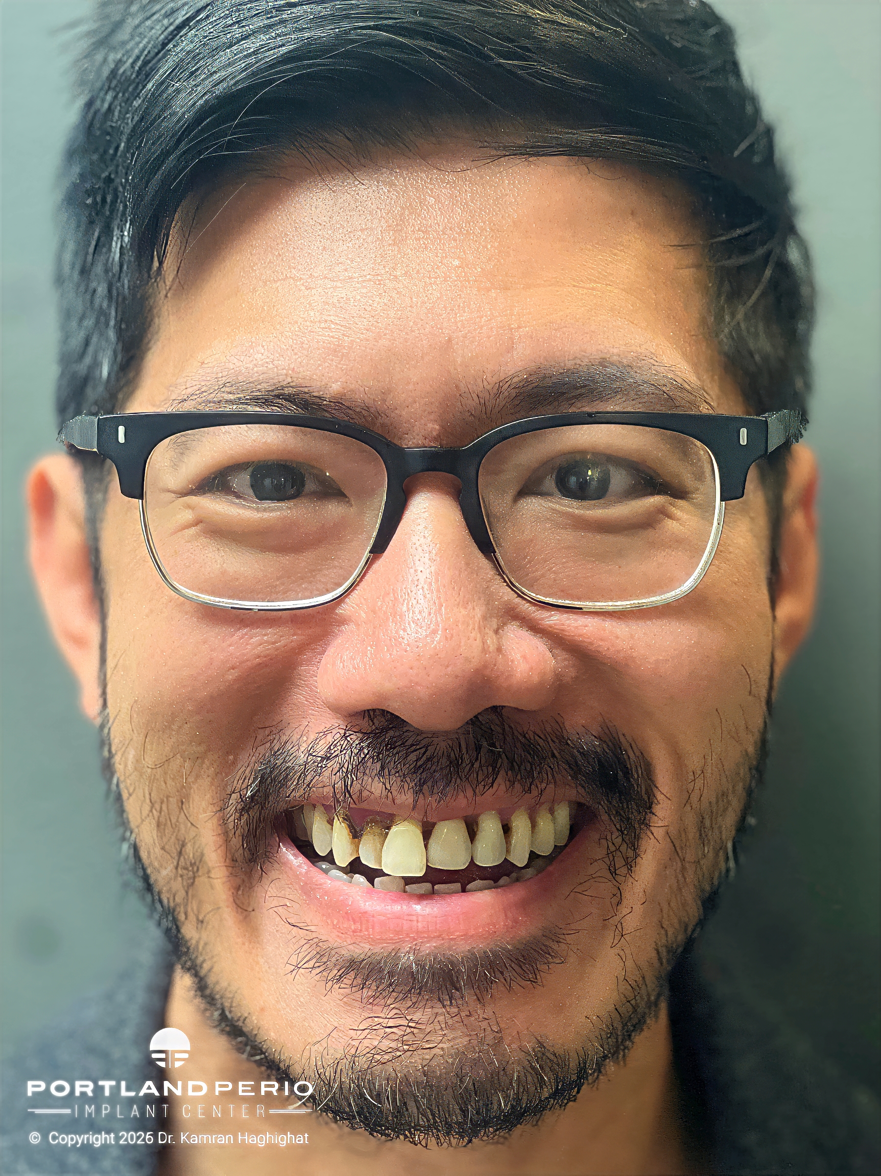 BEFORE - Patient Story - Dr. Kamran Haghighat, Portland Perio Implant Center